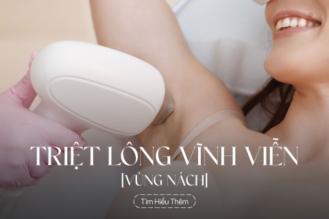 Triệt lông vùng nách vĩnh viễn